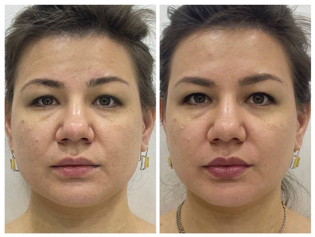 Результат до и после программы FaceReset 21